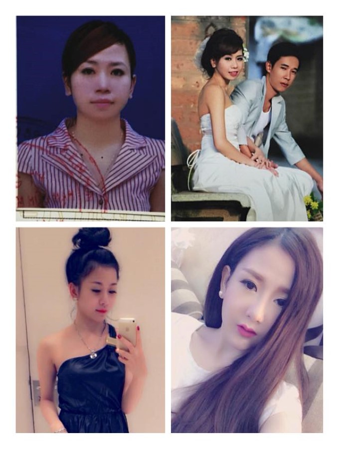 Chu Hằng phẫu thuật thẩm mỹ