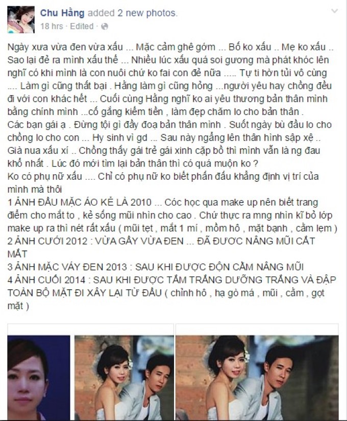 Chu Hằng phẫu thuật thẩm mỹ