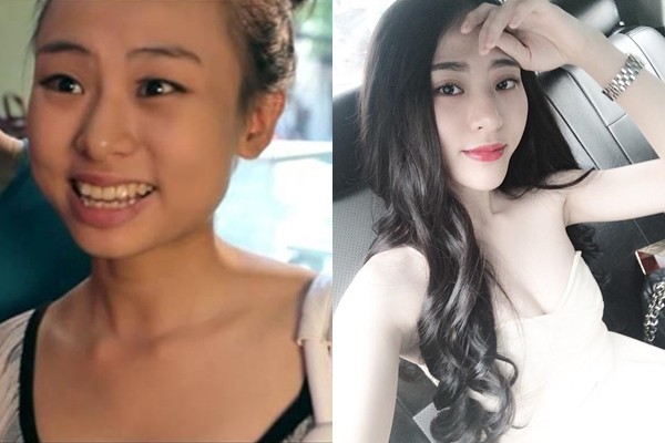 chất làm đầy filler