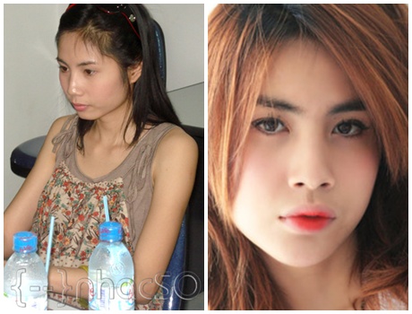 Thủy Tiên trước và sau khi thẩm mỹ