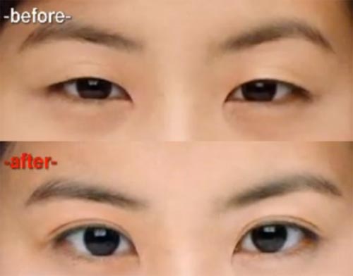 phẫu thuật thẩm mỹ