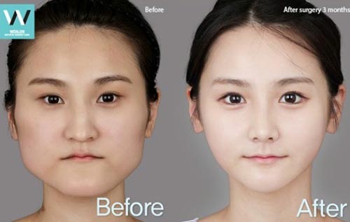 phẫu thuật thẩm mỹ