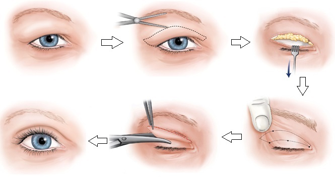 phẫu thuật cắt da thừa mí mặt