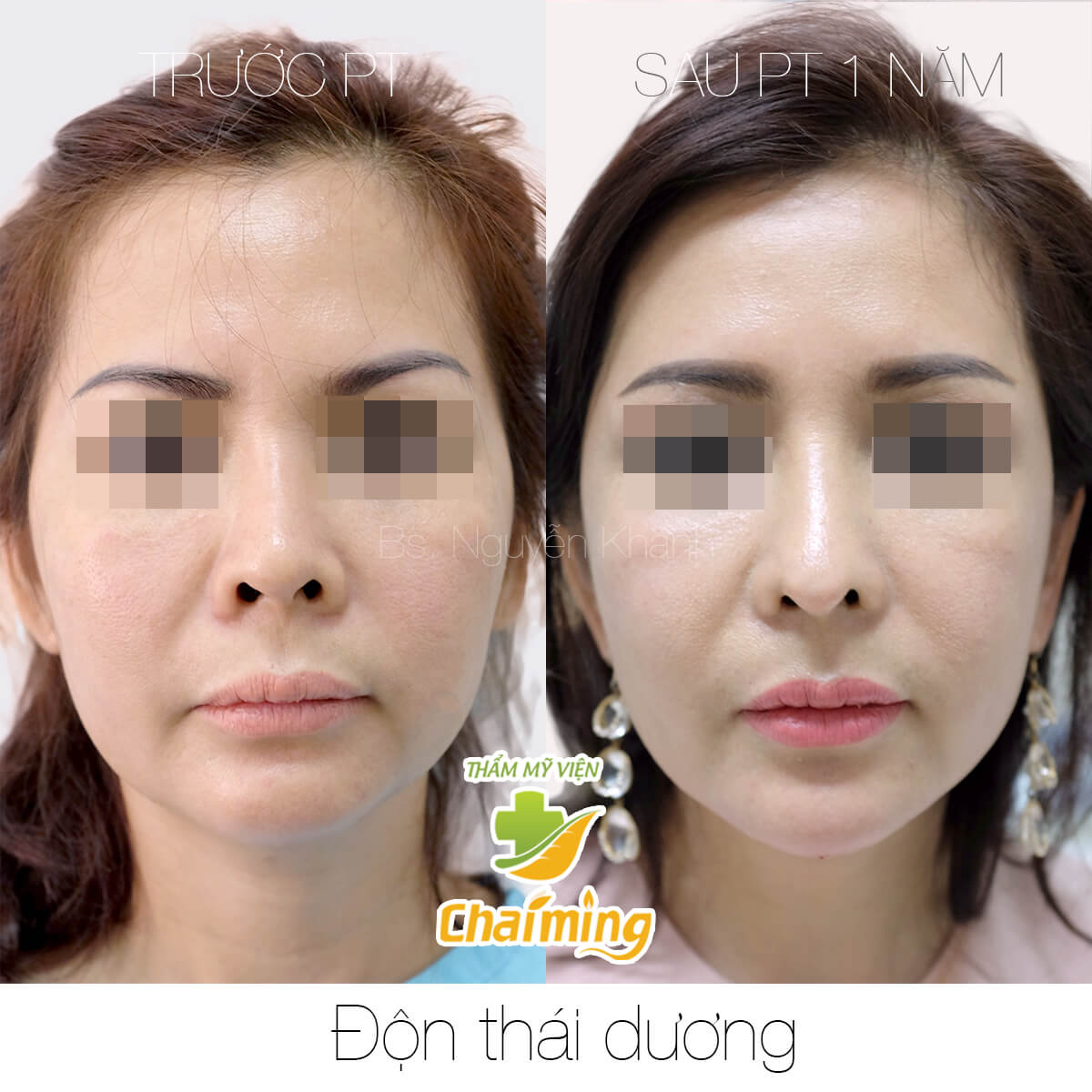 độn thái dương