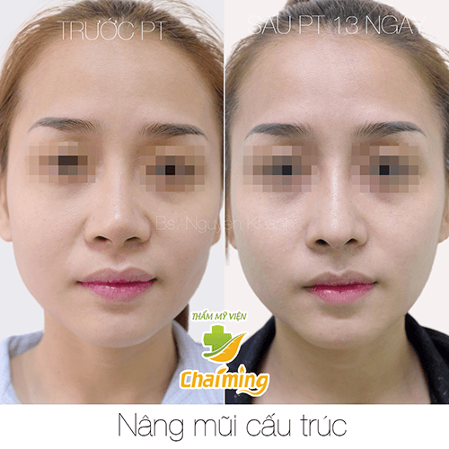 nâng mũi cấu trúc