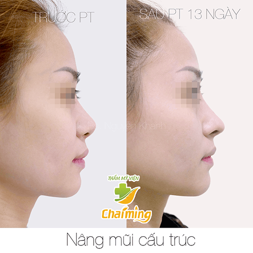 nâng mũi cấu trúc