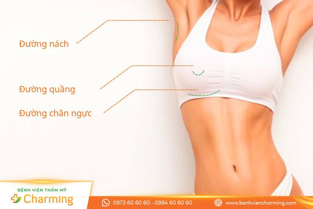 Các đường đặt túi ngực thường được chỉ định
