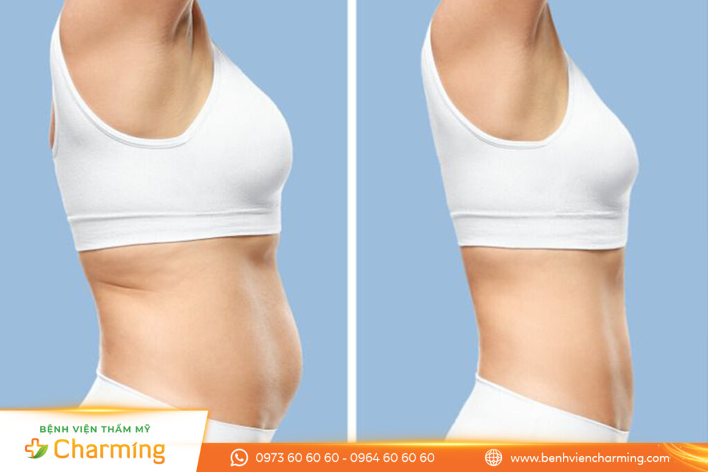 Loại bỏ mờ thừa vùng bụng giúp chị em sở hữu vóc dáng thon gọn, ưng ý