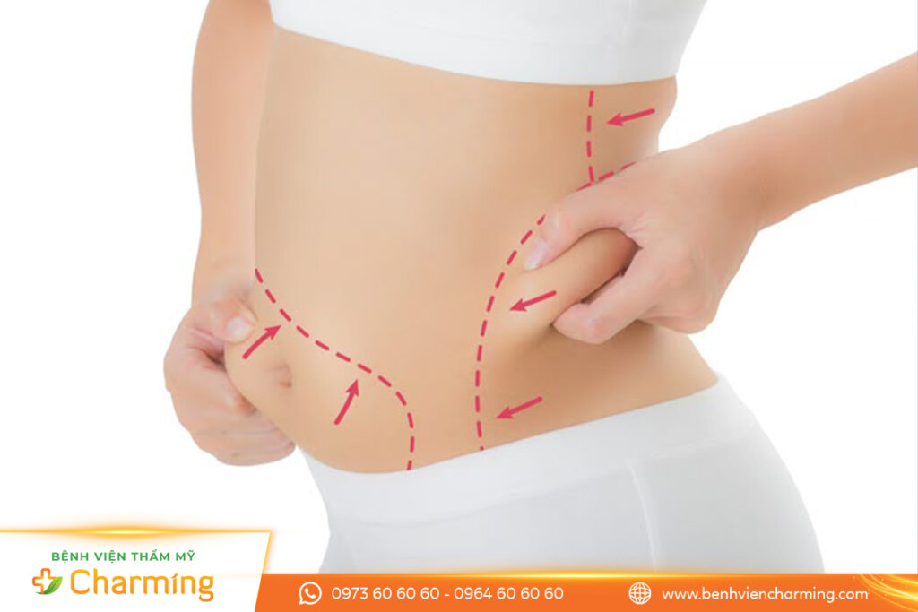 Nhiều chị em lựa chọn phương pháp hút mỡ để tìm lại vóc dáng hoàn hảo