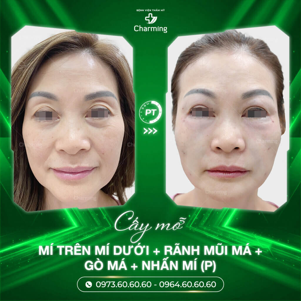 Khách hàng thực hiện dịch vụ cấy mỡ